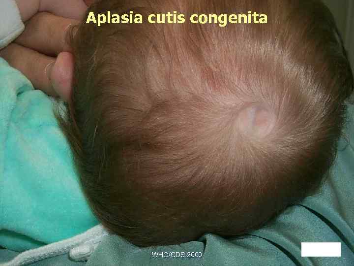 Aplasia cutis congenita WHO/CDS 2000 