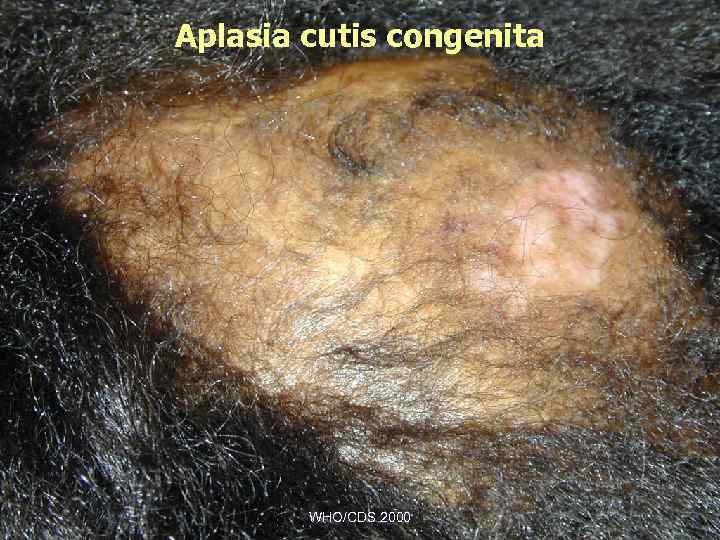 Aplasia cutis congenita WHO/CDS 2000 
