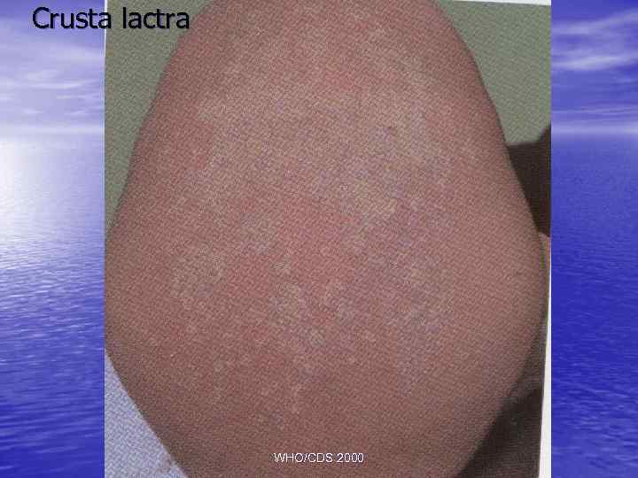 Crusta lactra WHO/CDS 2000 