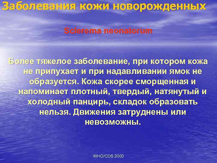 Заболевания кожи новорожденных Sclerema neonatorum Более тяжелое заболевание, при котором кожа не припухает и