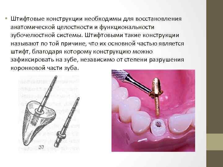  • Штифтовые конструкции необходимы для восстановления анатомической целостности и функциональности зубочелюстной системы. Штифтовыми