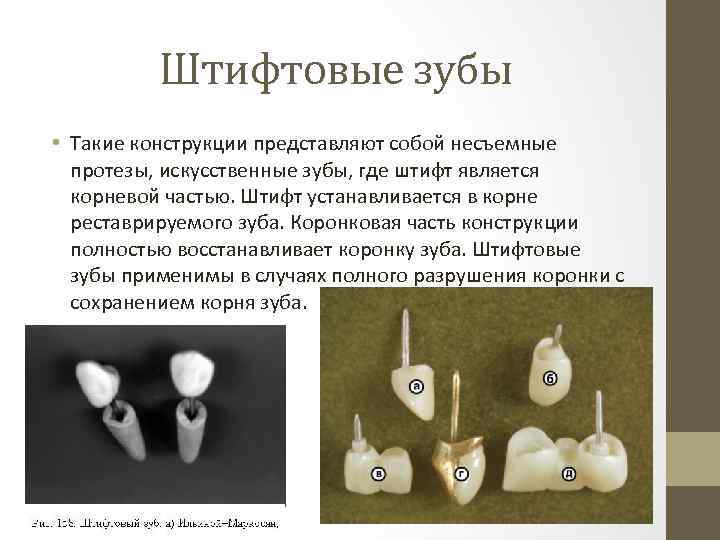 Штифтовые зубы • Такие конструкции представляют собой несъемные протезы, искусственные зубы, где штифт является