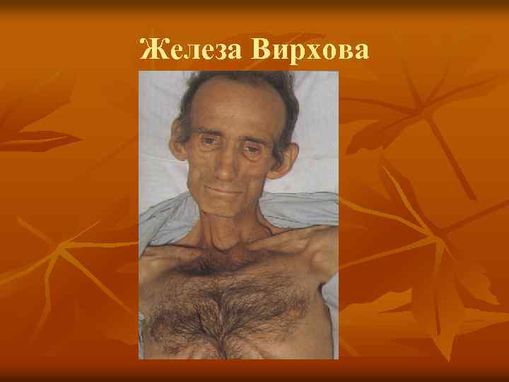 Железа Вирхова 