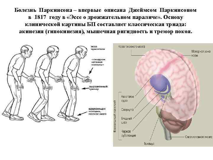 Болезнь Паркинсона – впервые описана Джеймсом Паркинсоном в 1817 году в «Эссе о дрожжательном