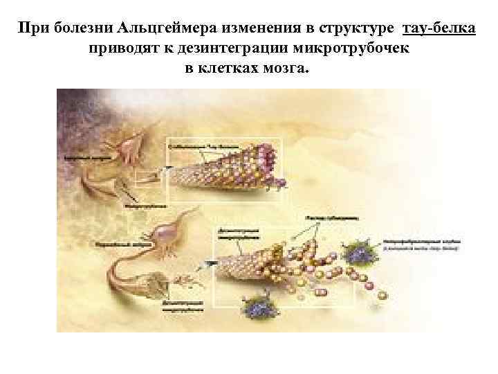 При болезни Альцгеймера изменения в структуре тау-белка приводят к дезинтеграции микротрубочек в клетках мозга.