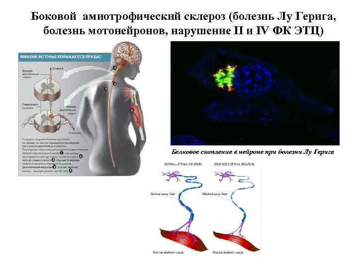 Боковой амиотрофический склероз (болезнь Лу Герига, болезнь мотонейронов, нарушение II и IV ФК ЭТЦ)