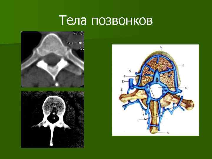 Тела позвонков 