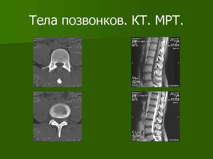 Тела позвонков. КТ. МРТ. 