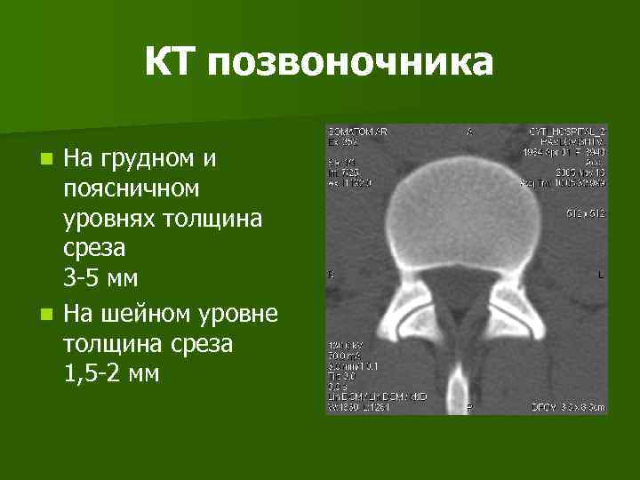 КТ позвоночника На грудном и поясничном уровнях толщина среза 3 -5 мм n На