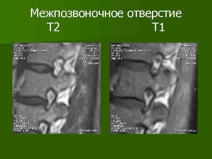 Межпозвоночное отверстие Т 2 Т 1 
