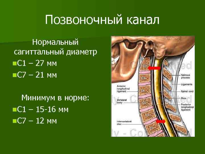 Позвоночный канал Нормальный сагиттальный диаметр n. С 1 – 27 мм n. С 7