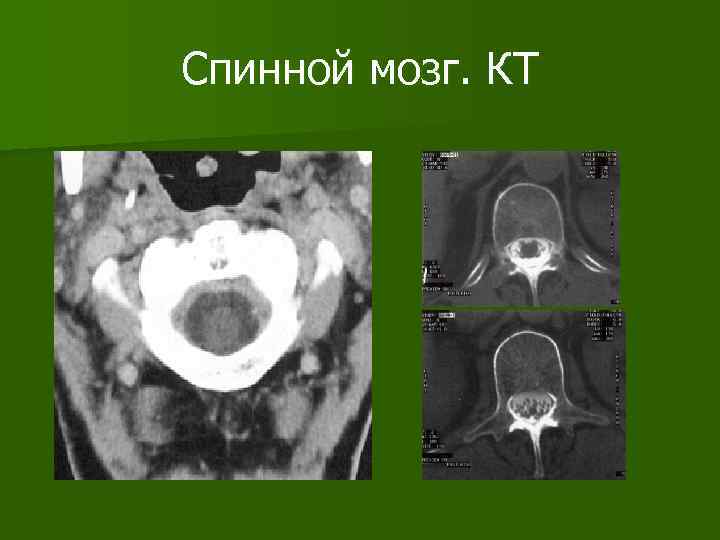 Спинной мозг. КТ 
