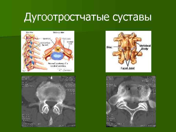 Дугоотростчатые суставы 