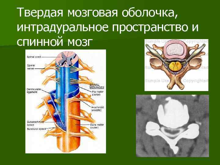 Твердая мозговая оболочка, интрадуральное пространство и спинной мозг 