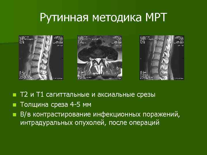 Рутинная методика МРТ Т 2 и Т 1 сагиттальные и аксиальные срезы n Толщина