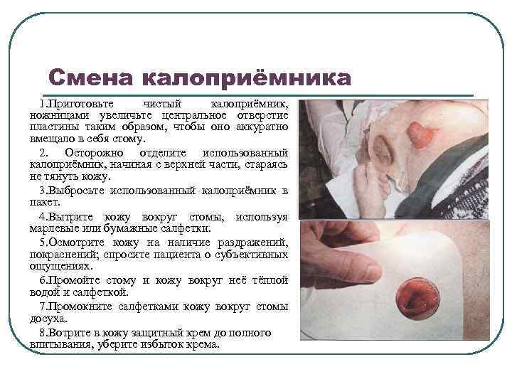 Смена калоприёмника 1. Приготовьте чистый калоприёмник, ножницами увеличьте центральное отверстие пластины таким образом, чтобы