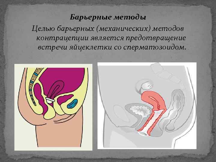 Барьерные методы Целью барьерных (механических) методов контрацепции является предотвращение встречи яйцеклетки со сперматозоидом. 