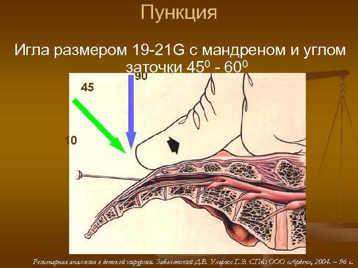 Пункция Игла размером 19 -21 G с мандреном и углом заточки 450 - 600