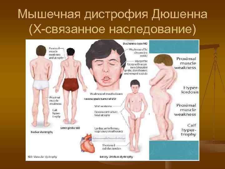 Мышечная дистрофия Дюшенна (Х-связанное наследование) 