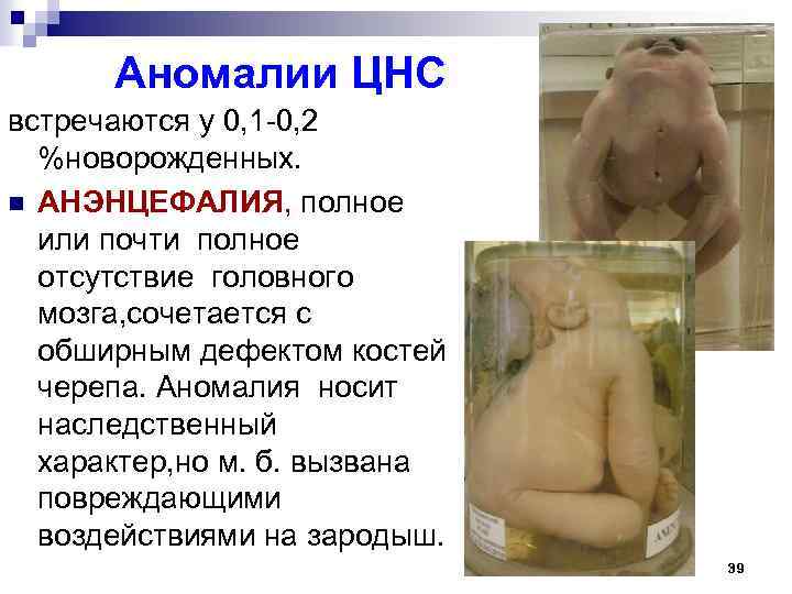 Аномалии ЦНС встречаются у 0, 1 -0, 2 %новорожденных. n АНЭНЦЕФАЛИЯ, полное или почти