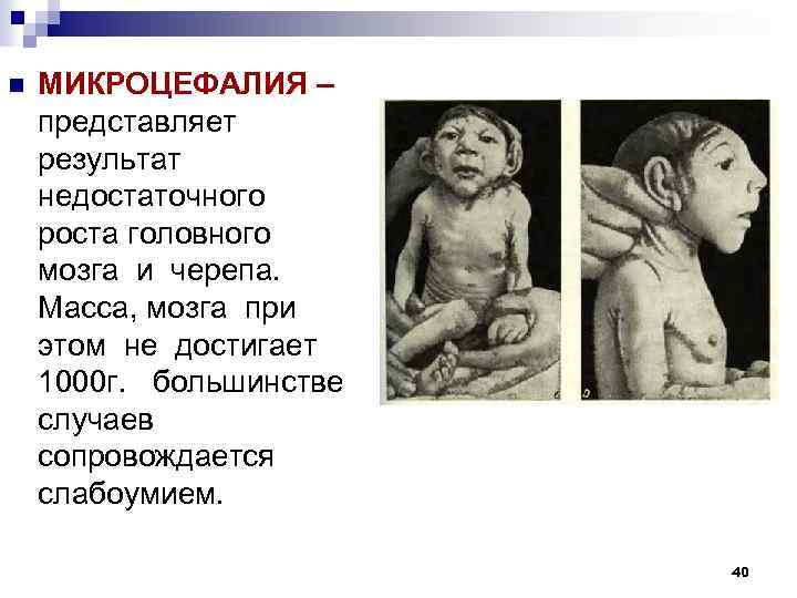 n МИКРОЦЕФАЛИЯ – представляет результат недостаточного роста головного мозга и черепа. Масса, мозга при