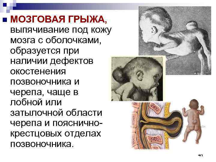 n МОЗГОВАЯ ГРЫЖА, выпячивание под кожу мозга с оболочками, образуется при наличии дефектов окостенения