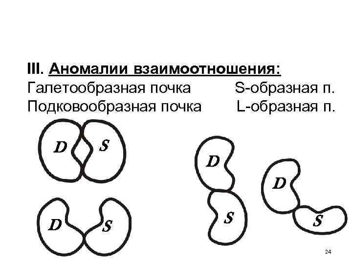 III. Аномалии взаимоотношения: Галетообразная почка S-образная п. Подковообразная почка L-образная п. D S D