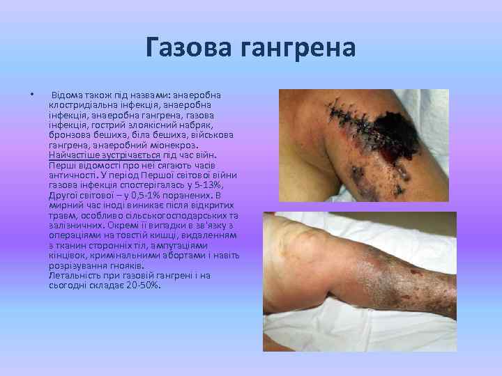 Газова гангрена • Відома також під назвами: анаеробна клостридіальна інфекція, анаеробна гангрена, газова інфекція,