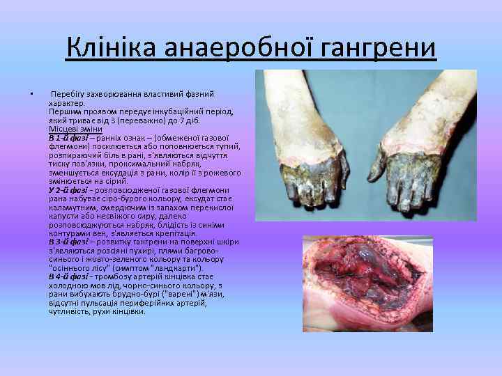 Клініка анаеробної гангрени • Перебігу захворювання властивий фазний характер. Першим проявом передує інкубаційний період,