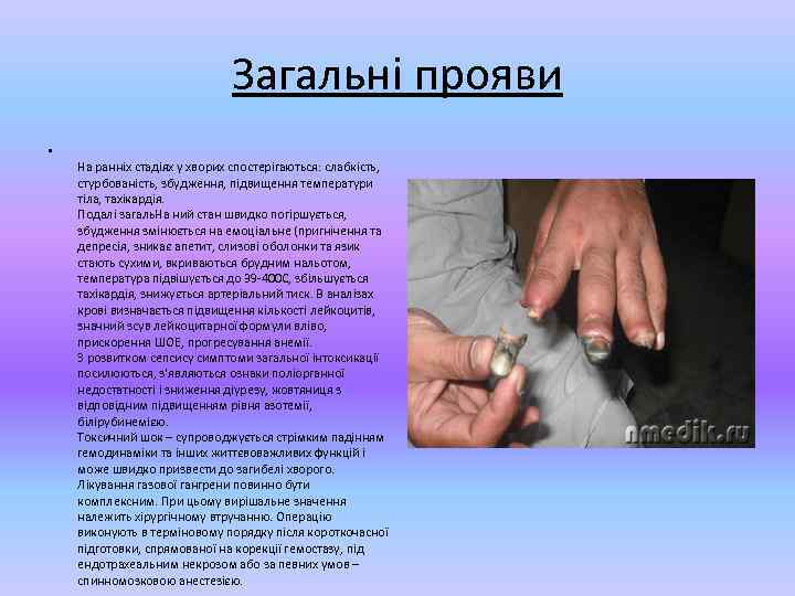 Загальні прояви • На ранніх стадіях у хворих спостерігаються: слабкість, стурбованість, збудження, підвищення температури