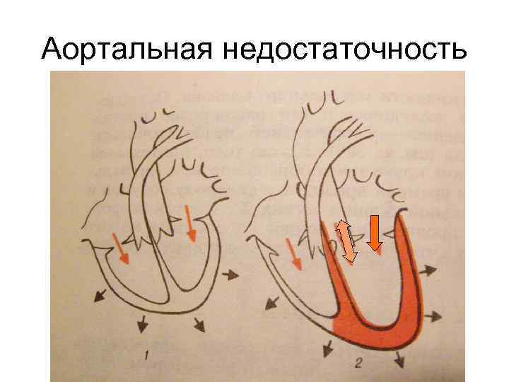 Аортальная недостаточность 