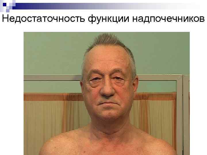 Недостаточность функции надпочечников 