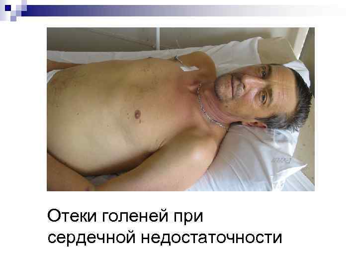 Отеки голеней при сердечной недостаточности 