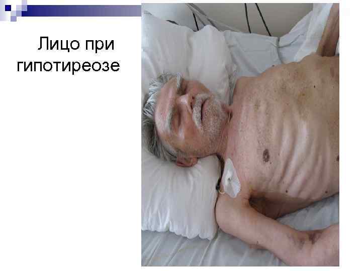 Лицо при гипотиреозе 