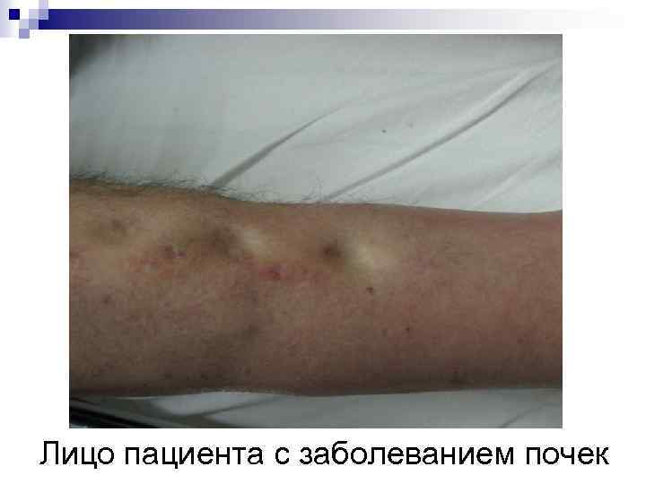 Лицо пациента с заболеванием почек 