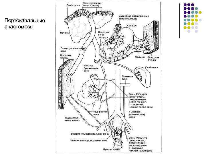 Портокавальные анастомозы 