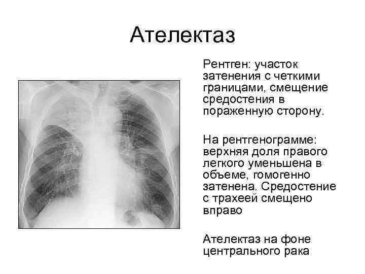 Ателектаз Рентген: участок затенения с четкими границами, смещение средостения в пораженную сторону. На рентгенограмме: