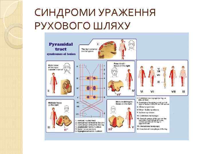 СИНДРОМИ УРАЖЕННЯ РУХОВОГО ШЛЯХУ 