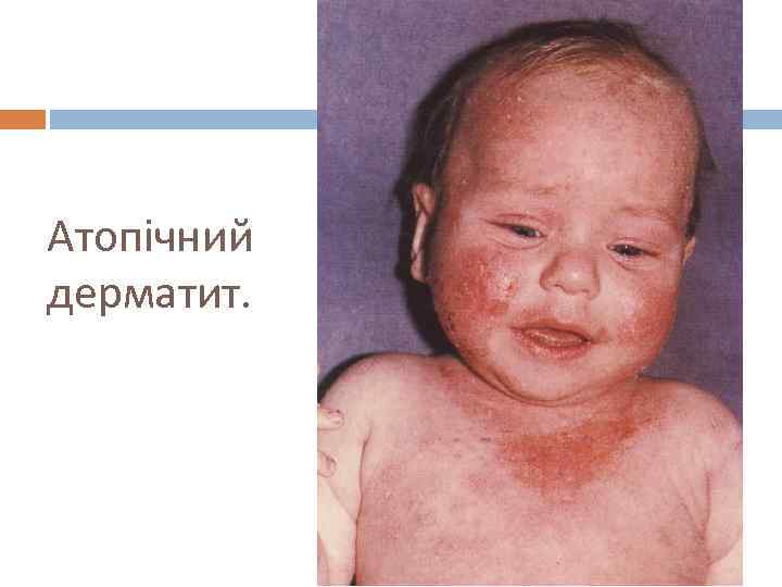 Атопічний дерматит. 