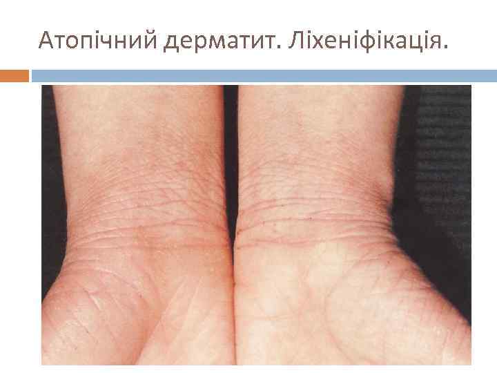 Атопічний дерматит. Ліхеніфікація. 