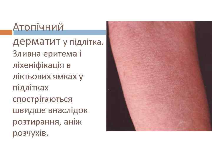 Атопічний дерматит у підлітка. Зливна еритема і ліхеніфікація в ліктьових ямках у підлітках спострігаються