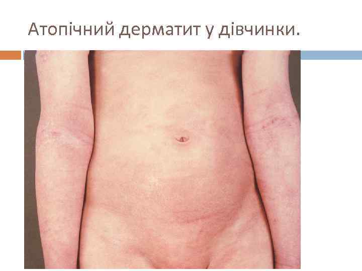 Атопічний дерматит у дівчинки. 