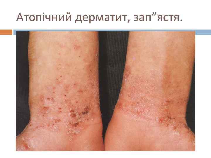 Атопічний дерматит, зап”ястя. 