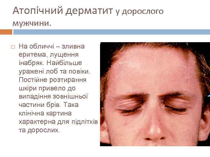 Атопічний дерматит у дорослого мужчини. На обличчі – зливна еритема, лущення інабряк. Найбільше уражені