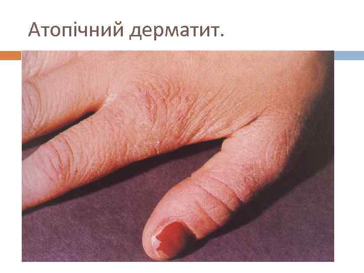 Атопічний дерматит. 