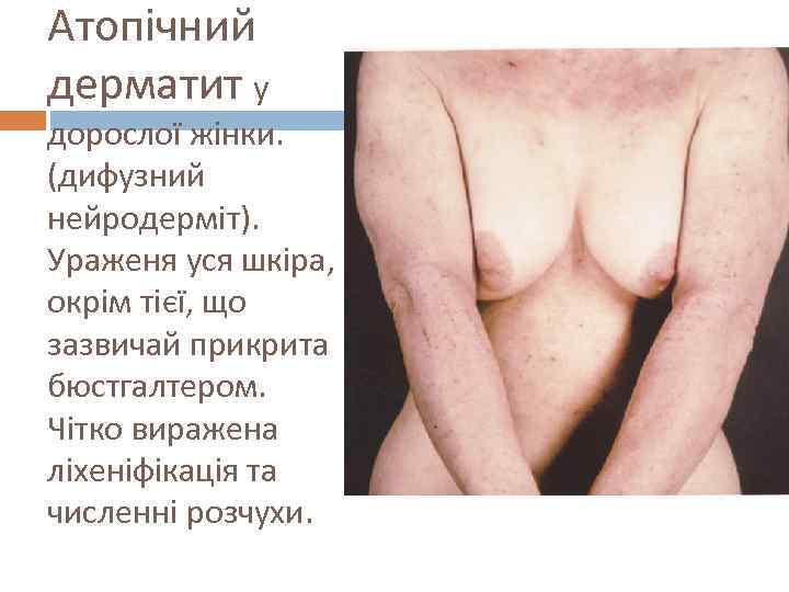 Атопічний дерматит у дорослої жінки. (дифузний нейродерміт). Ураженя уся шкіра, окрім тієї, що зазвичай