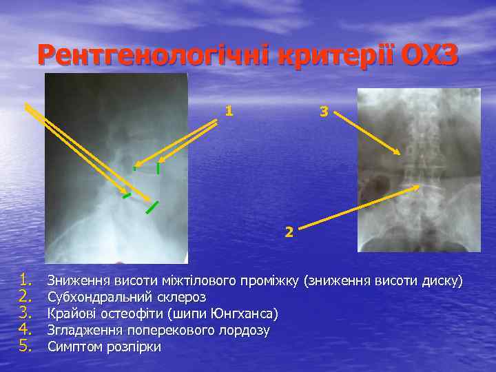 Рентгенологічні критерії ОХЗ 1 3 2 1. 2. 3. 4. 5. Зниження висоти міжтілового