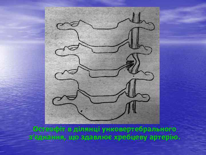 Остеофіт в ділянці унковертебрального з’єднання, що здавлює хребцеву артерію. 
