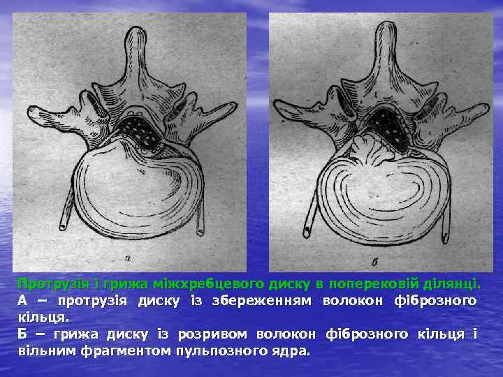 Протрузія і грижа міжхребцевого диску в поперековій ділянці. А – протрузія диску із збереженням