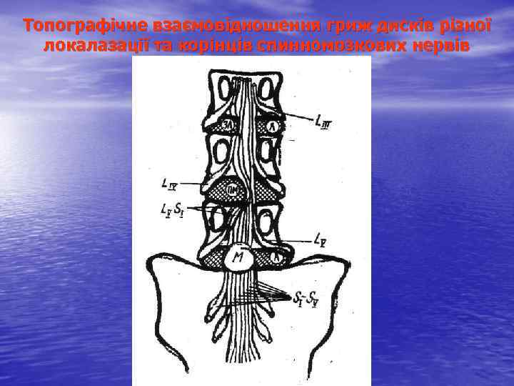 Топографічне взаємовідношення гриж дисків різної локалазації та корінців спинномозкових нервів 